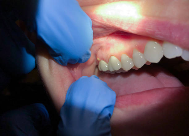 Best Emergency Wisdom Tooth Extraction in Riverside, OH